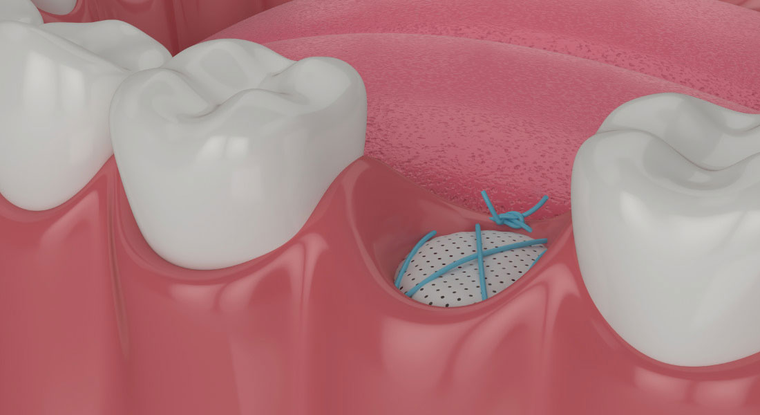 cabinet saint guillaume les dents chez l adulte les implants les greffes osseuses pre implantaires 02