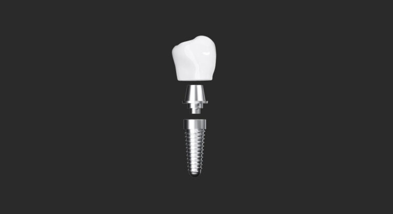 cabinet saint guillaume les implants prothese dentaire sur implant 02