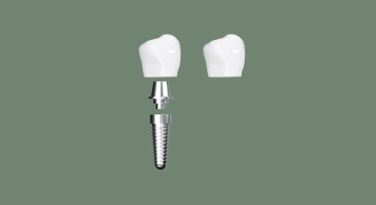 cabinet saint guillaume les implants quelles differences entre implant et inlay core 02