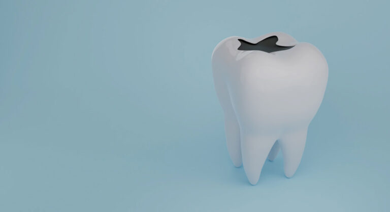 cabinet saint guillaume les pathologies bucco dentaires caries et soins des caries 02
