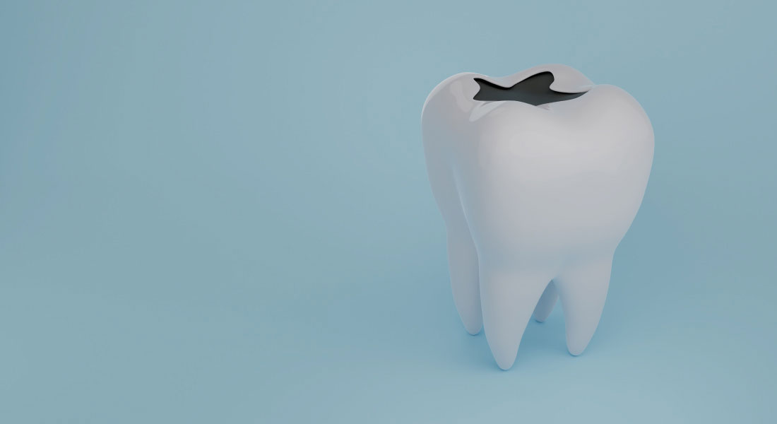 cabinet saint guillaume les pathologies bucco dentaires caries et soins des caries 02