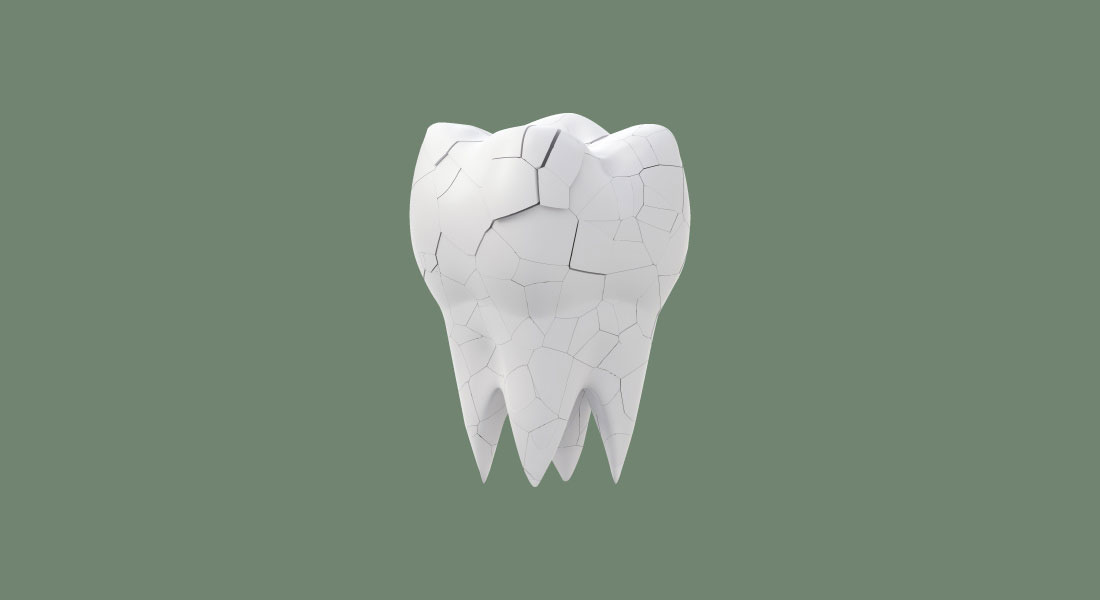 cabinet saint guillaume les pathologies bucco dentaires la mylolyse dentaire ou lesion cervicale d usure 02